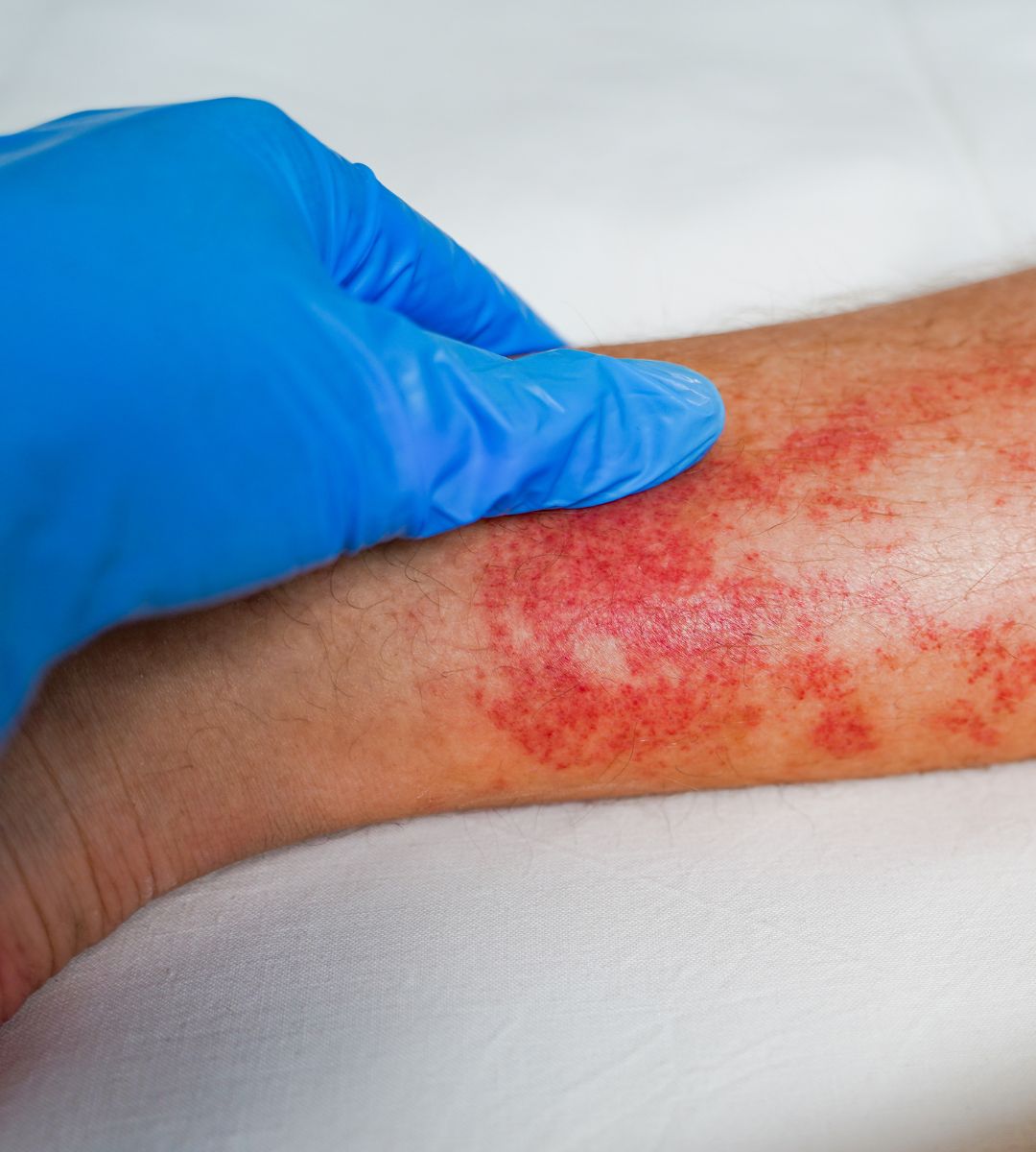 Mężczyzna umiera na wściekliznę po przeszczepie nerki Foto: zadrapanie na nodze