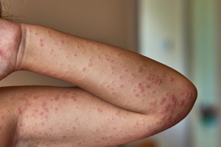 Wielka Brytania straciła status kraju wolnego od odry Foto: ręka chorego na odrę pokryta wysypką