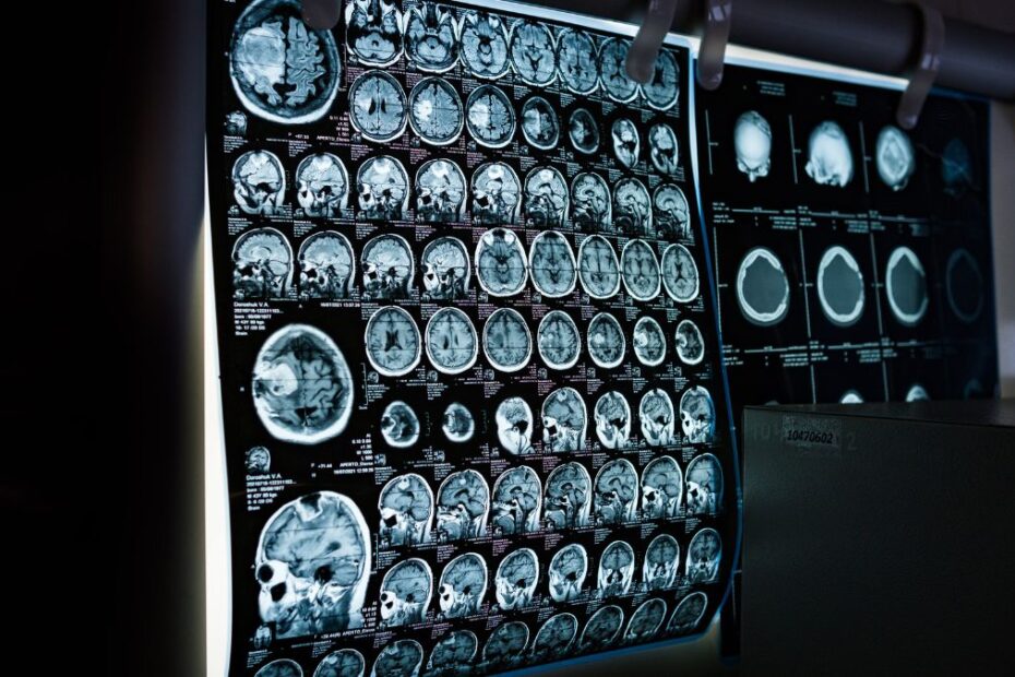 Co ma wspólnego menopauza z chorobą alzheimera Foto: tomografia