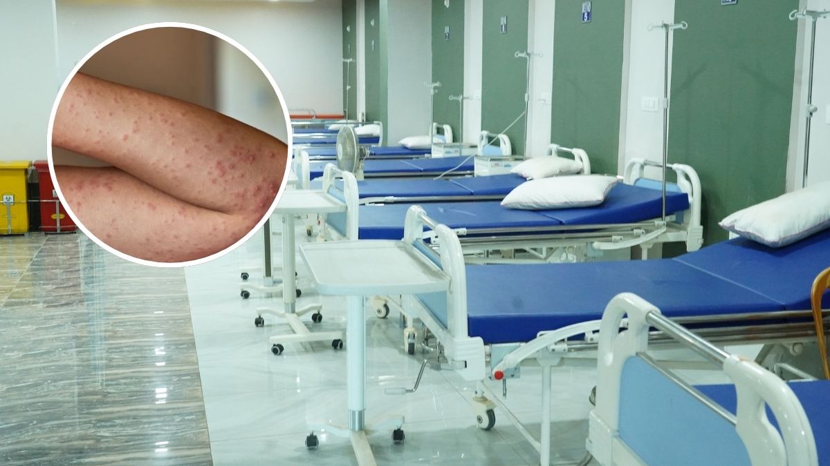 Kolejna śmiertelna ofiara odry w Anglii Foto: oddział szpitalny