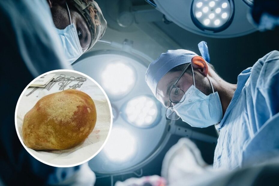 Lekarze wyjęli z pęcherza mężczyzny 3 kilogramowy kamień Foto: sala operacyjna, zdjęcie wyjętego kamienie w kółku