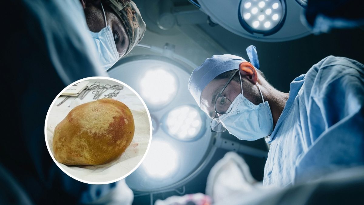 Lekarze wyjęli z pęcherza mężczyzny 3 kilogramowy kamień Foto: sala operacyjna, zdjęcie wyjętego kamienie w kółku