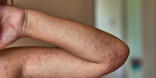 Wielka Brytania straciła status kraju wolnego od odry Foto: ręka chorego na odrę pokryta wysypką